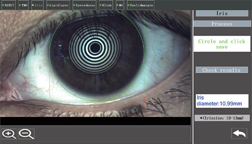 MEASUREMENT OF IRIS DIAMETER