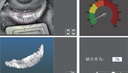 MEIBOMIAN GLAND IMAGING