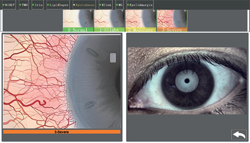 EYE REDNESS ANALYSIS